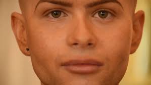 How does it feel when botox first starts working? My Lips Turned Blue And Started Splitting After I Had Fillers Wales Online
