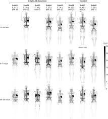 Revolutionary Technique Reveals How the Body’s Immune System Fights COVID-19 Infection