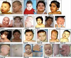 Genetic and rare diseases information center. Pallister Killian Syndrome Causes Symptoms Diagnosis Treatment Prognosis