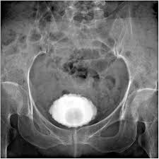 Image result for Voiding Cystourethrogram