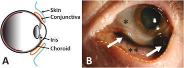 Image result for conjunctival melanoma