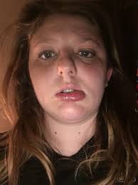 I Had An Allergic Reaction And I Am Uncertain What I Was Allergic To I Have Found That Two Benadryl And One Zyrtec And Carme Zyrtec Benadryl Allergic Reaction