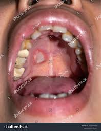 Image result for Mouth ulcers roof of mouth