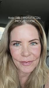 It's time to announce our giveaway winners of the day!! 🎉🎁  ▫️▫️▫️▫️▫️▫️▫️▫️ Winner of the Free BBL Face Treatment