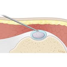 Image result for Biceps Tendon Injection
