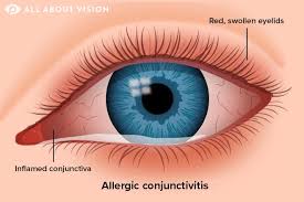 Image result for Conjunctivitis