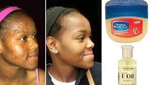 Check spelling or type a new query. How Vaseline With Vitamin E Oil Can Change Your Skin Overnight