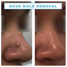 Image result for skin cancer on nose pimple