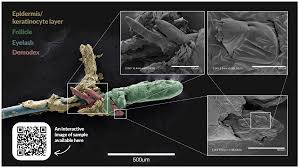 Image result for Demodex folliculorum