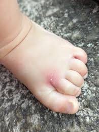 Image result for ant bite
