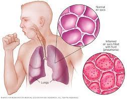 If we don't have enough oxygen then we can't cool our bodies and can get heat stroke from that. Pneumonia And Your Lungs Mayo Clinic