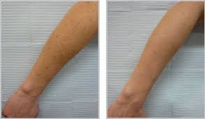 Koldaki Gunes Lekeleri Nasil Gecer Guneslekeleri Gen Tr