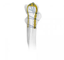 Olecranon U-Locking Plate,Medical Device Manufacturers ...