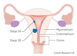 This process, known as staging, takes into account. Endometrial Cancer Uterine Nzgcf