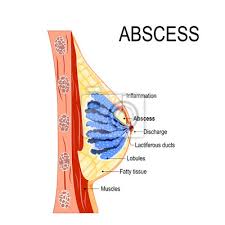 Abszess Querschnitt Der Brustdruse Mit Entzundung Der Brust Fototapete Fototapeten Frau Abschnitt Forschung Myloview De