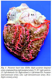 Where are the diagonal branches of the ramus intermedius artery? Braz J Cardiovasc Surg Right Coronary Artery Anatomy Anatomical And Morphometric Analysis