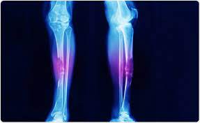 At first, the pain is not constant. Causes And Symptoms Of Bone Cancer