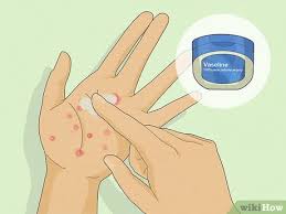 Image result for dyshidrosis