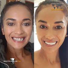 Presson Veneers Brighter Image Lab Official Site Bil Veneers Dental Implants Cost Cosmetic Dentistry Beauty Hacks Veneers Teeth
