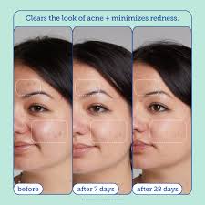 acne+ Adapinoid® Gel