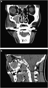Check spelling or type a new query. Entrapment Of Inferior Rectus Muscle As A Complication Of Sinus Balloon Expansion For Maxillary Sinus Fracture Eye