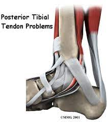 Physical Therapy In Long Island For Posterior Tibial Tendon Problems