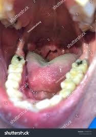 Image result for Tonsillolith