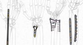 FREEFIX® Forearm Plating System - Skeletal Dynamics