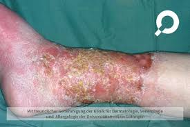 Image result for erysipel photos)