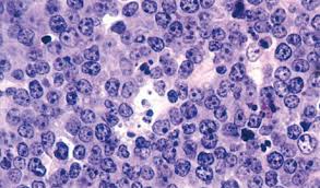 whats the difference between hodgkin and non hodgkin lymphoma