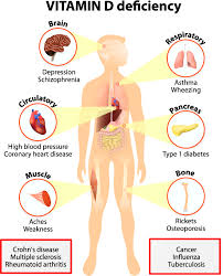 11 Vital Signs And Symptoms Of Vitamin D Deficinecy