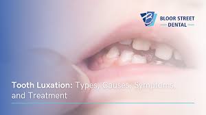 Image result for Tooth Luxation