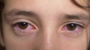 Folgen, risiken und mögliche komplikationen. Rote Augen Beim Kind Mogliche Ursachen Und Behandlungsmoglichkeiten