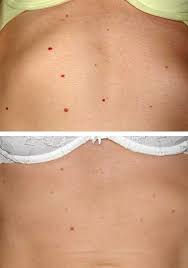 Cherry angioma removal made easy with cryopen red small dots are considered harmless and painless. Cherry Angioma Removal Carlisle Perfect Your Skin Vl Aesthetics