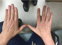 The Management Of Persistent And Recurrent Cubital Tunnel Syndrome Journal Of Hand Surgery