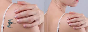 Address san francisco medical center 1600 owens street dermatology dept., 9th floor san francisco, ca 94158. Tattoo Removal Usha Rajagopal Md