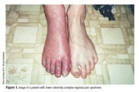 Pin On Crps Rsd Facts Complex Regional Pain Syndrome Reflexive Sympathetic Dystrophy