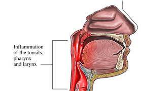 Dolor De Garganta Western New York Urology Associates Llc