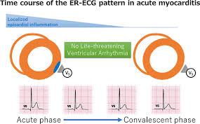 In myocarditis, ecg is an asset to find out abnormal heart rhythms. Prevalence And Significance Of An Early Repolarization Electrocardiographic Pattern And Its Mechanistic Insight Based On Cardiac Magnetic Resonance Imaging In Patients With Acute Myocarditis Circulation Arrhythmia And Electrophysiology