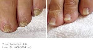 Image result for mykoza nehtů