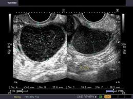 It then converts this data into a visual representation of how fast and in what direction blood is flowing. A Gallery Of High Resolution Ultrasound Color Doppler 3d Images Ovaries Ovarian Cyst Ultrasound Ovaries