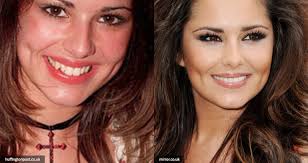 21 Celebrities With Dental Implants Or Cosmetic Dentistry