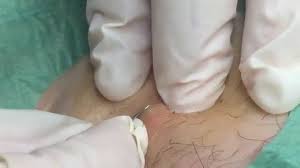 We recommend you always get this checked by a doctor. Ingrown Hair Removal Youtube