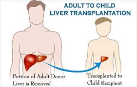 An estimated 72 percent of people are still alive 5 years after liver transplant surgery. Adult To Child Living Donor Liver Transplantation