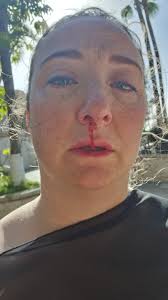 Be careful riding the multisurf at Aqualand. The water didn't stop me and I  went head first into concrete and busted my nose. Cut glued together. The  splash areas are great, but