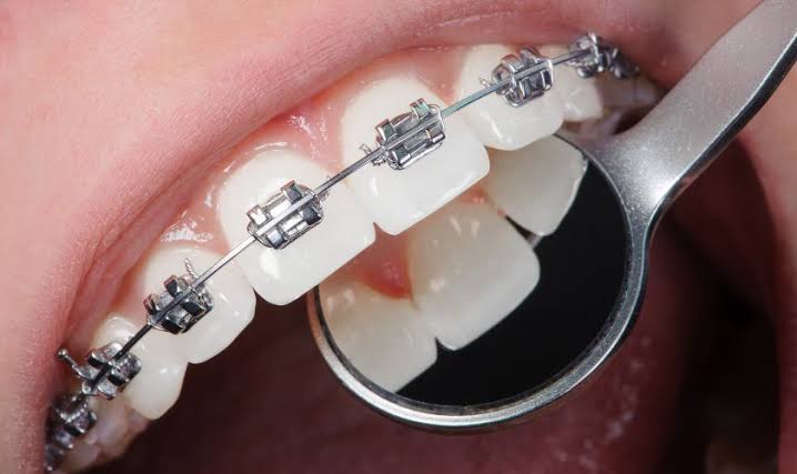 Kids Orthodontics Pittsford: Guide to Building Confident Smiles