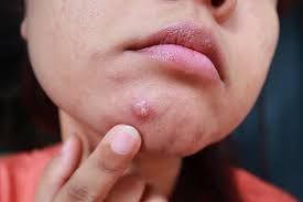 Image result for acne face