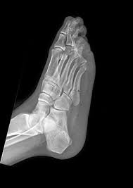 Avulsion fractures occur when the capsule, ligaments or tendons are avulsed from the bone due to unexpected contraction of the muscles or mechanical force 1. Typical Example Of A Jones Fracture Not To Be Confused With An Avulsion Fracture Of The Styloid Process Pseudo Jon Jones Fracture Radiology Radiology Imaging