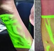 Use of a near-infrared vein finder to assess the extent of a ...