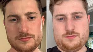 Mumps was common in the united however, mumps outbreaks still occur in the united states, and the number of cases has crept up in. Mumps Symptoms Explained As Cases Surge In England Huffpost Uk Life